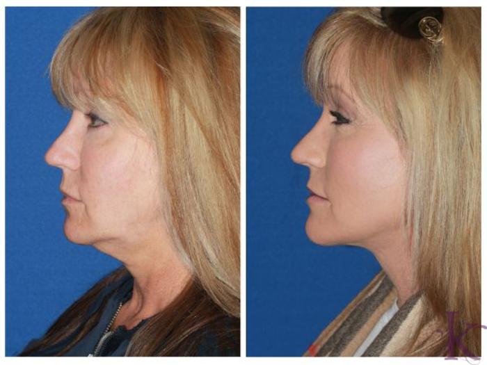 Before & After Facelift Case 30 View #3 View in New York, NY