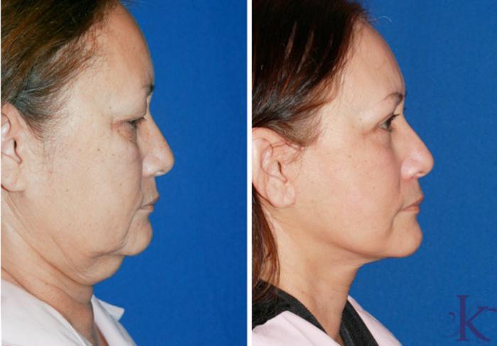 Before & After Facelift Case 58 View #3 View in New York, NY