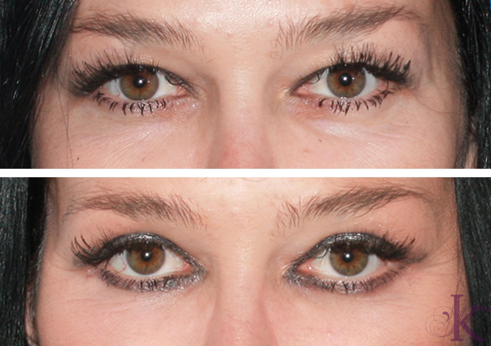 Before & After Blepharoplasty Case 117 Front View in New York, NY
