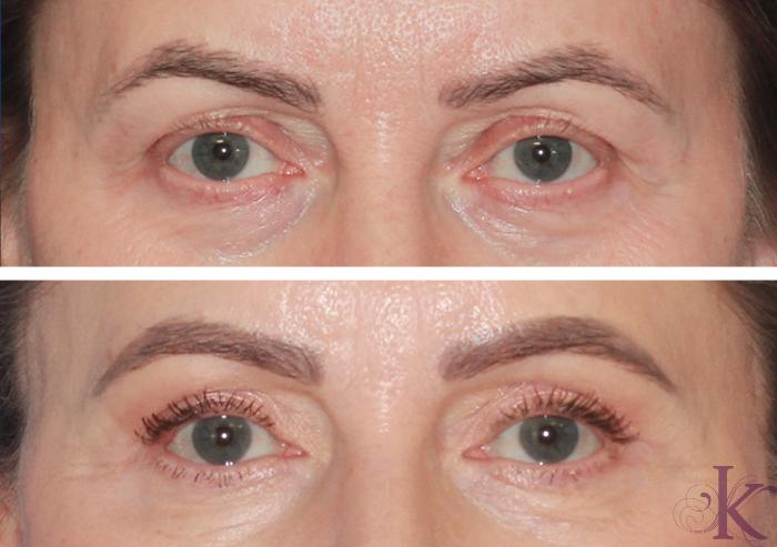 Before & After Blepharoplasty Case 120 Front View in New York, NY