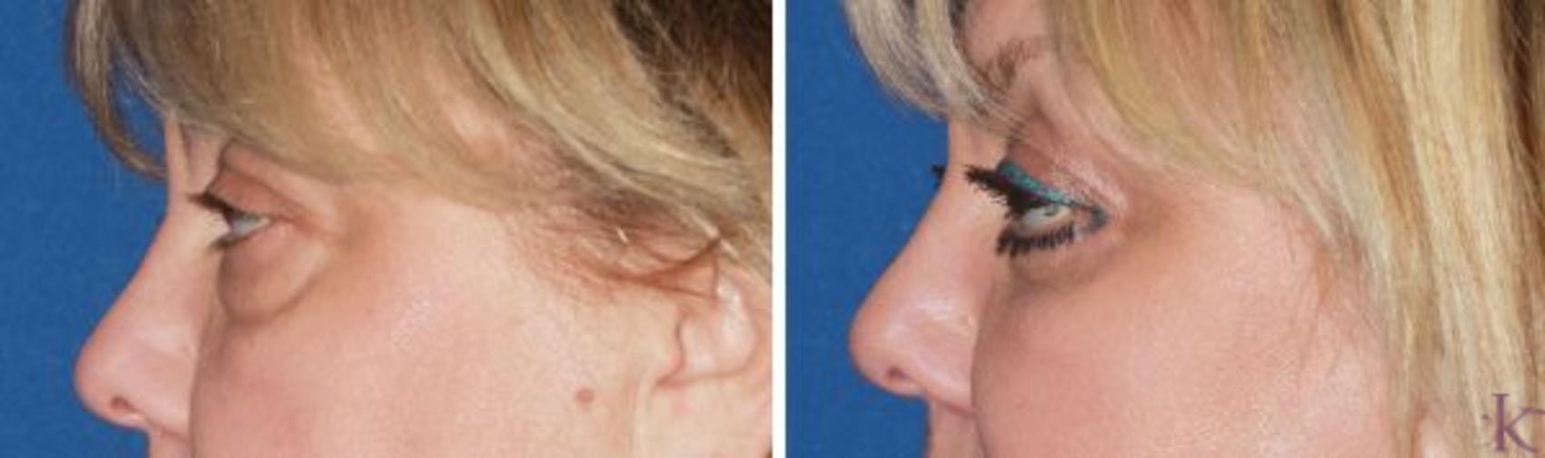 Before & After Blepharoplasty Case 47 View #1 View in New York, NY