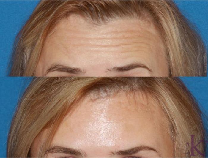 Before & After BOTOX, Dysport & Xeomin Case 37 View #1 View in New York, NY