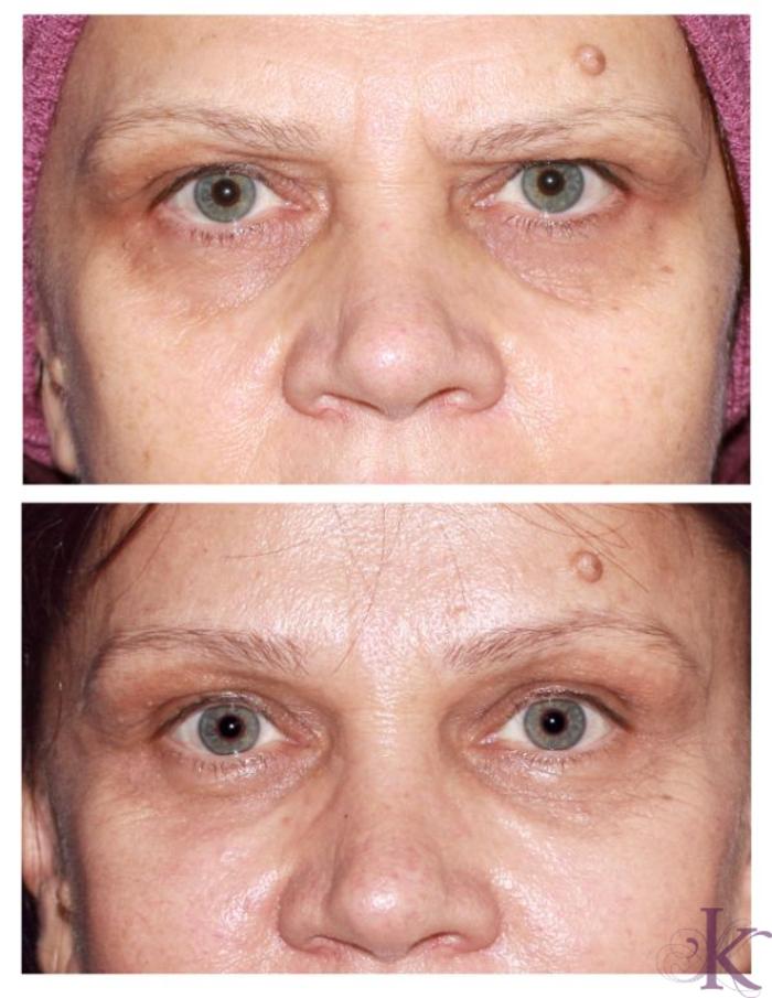 Before & After Browlift Case 71 View #1 View in New York, NY