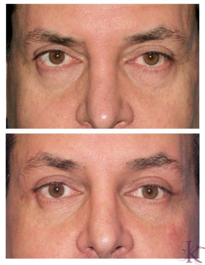 Before & After Browlift Case 72 View #1 View in New York, NY