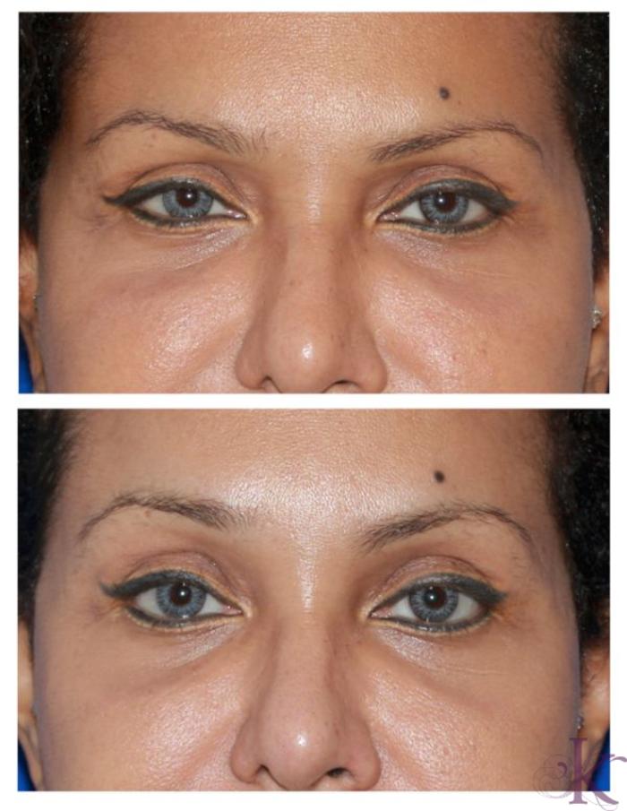 Before & After Browlift Case 73 View #1 View in New York, NY