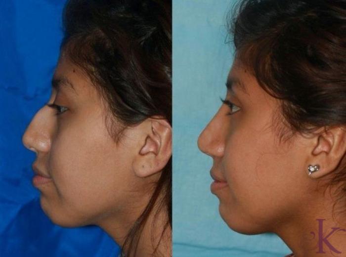Before & After Cosmetic Rhinoplasty Case 13 View #1 View in New York, NY