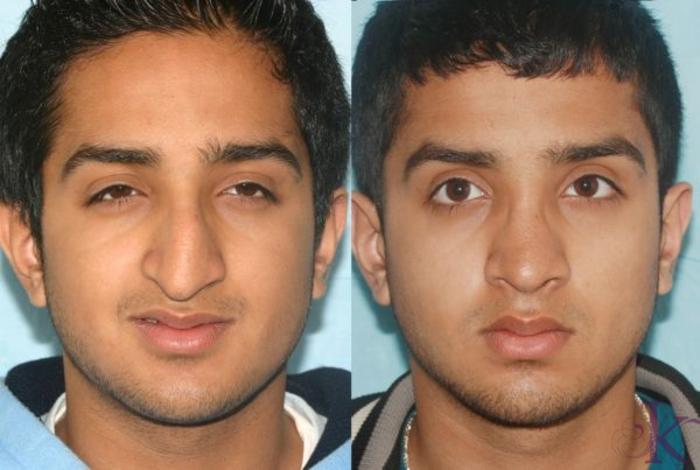 Before & After Cosmetic Rhinoplasty Case 14 View #1 View in New York, NY