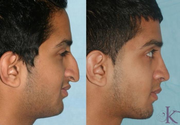 Before & After Cosmetic Rhinoplasty Case 14 View #2 View in New York, NY