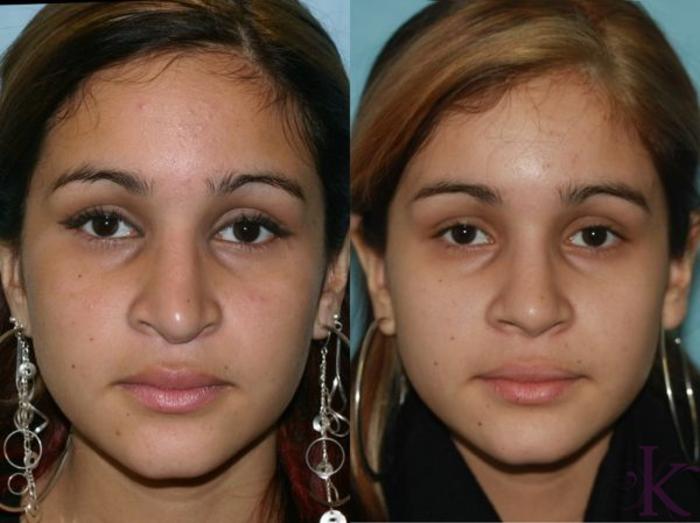 Before & After Cosmetic Rhinoplasty Case 16 View #1 View in New York, NY