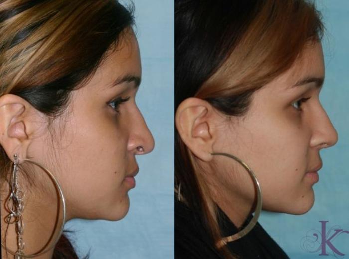 Before & After Cosmetic Rhinoplasty Case 16 View #2 View in New York, NY