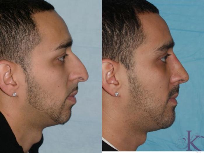 Before & After Cosmetic Rhinoplasty Case 17 View #1 View in New York, NY