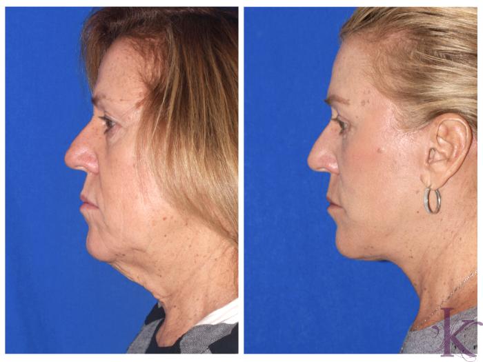 Before & After Facelift Case 104 View #3 View in New York, NY