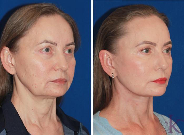Before & After Facelift Case 116 Right Oblique View in New York, NY