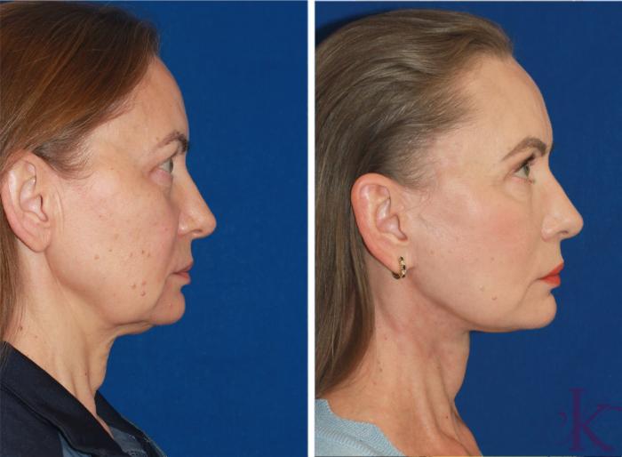 Before & After Facelift Case 116 Right Side View in New York, NY