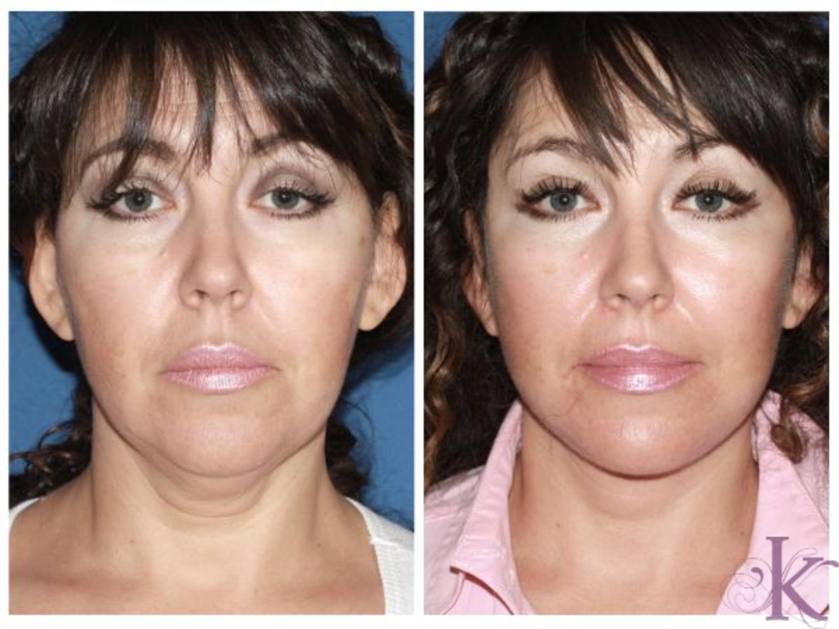 Deep Plane Facelift: la evolución del lifting - Clínica HB