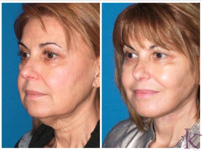 Before & After Facelift Case 41 View #2 View in New York, NY