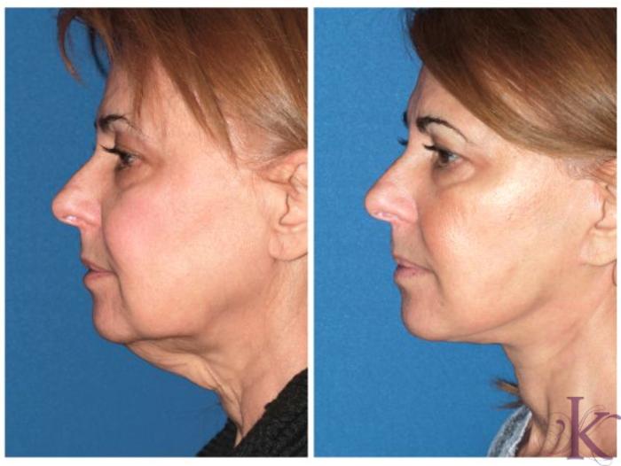 Before & After Facelift Case 41 View #3 View in New York, NY