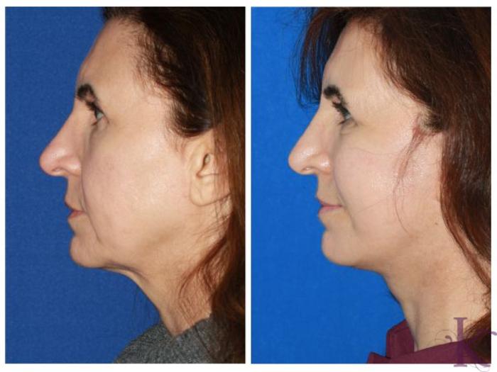 Before & After Facelift Case 45 View #3 View in New York, NY