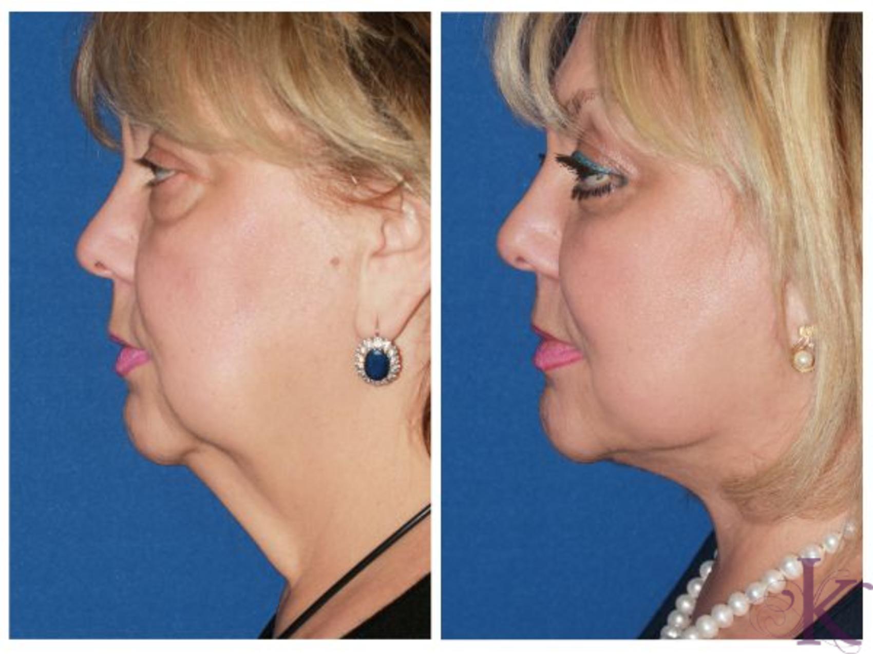 Facelift Dr Vasyukevich Facial Plastic Surgeon Nyc 46