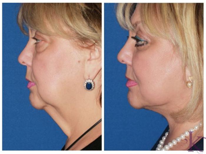 Before & After Facelift Case 46 View #3 View in New York, NY