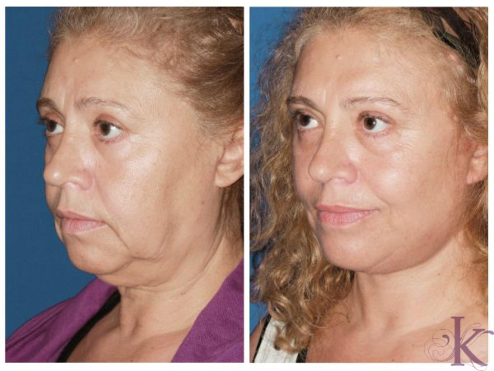 Facelift Dr Vasyukevich Facial Plastic Surgeon Nyc 50 2190