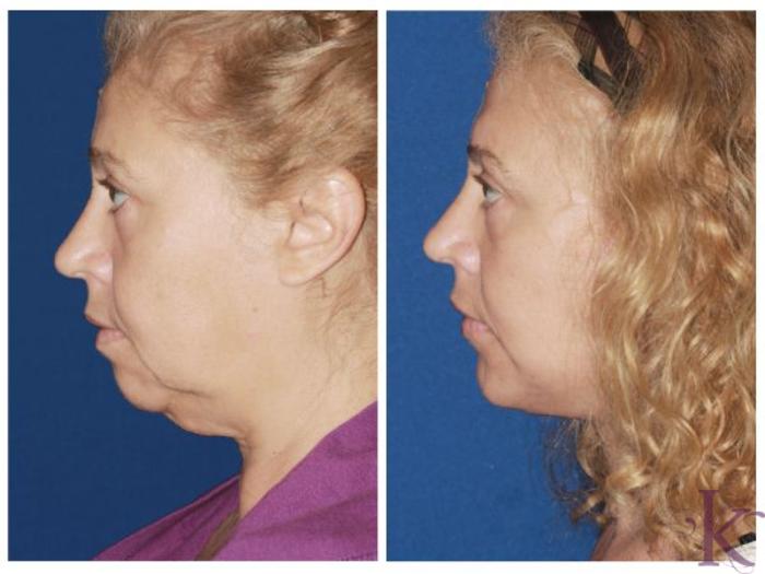 Before & After Facelift Case 50 View #3 View in New York, NY