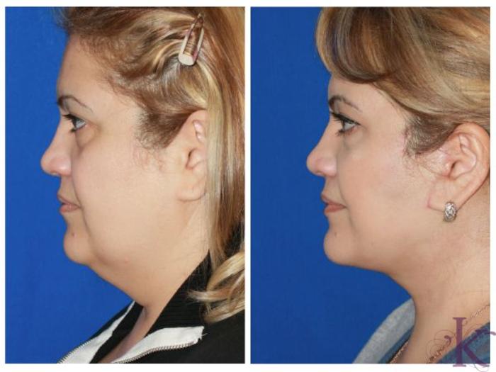 Before & After Facelift Case 51 View #3 View in New York, NY