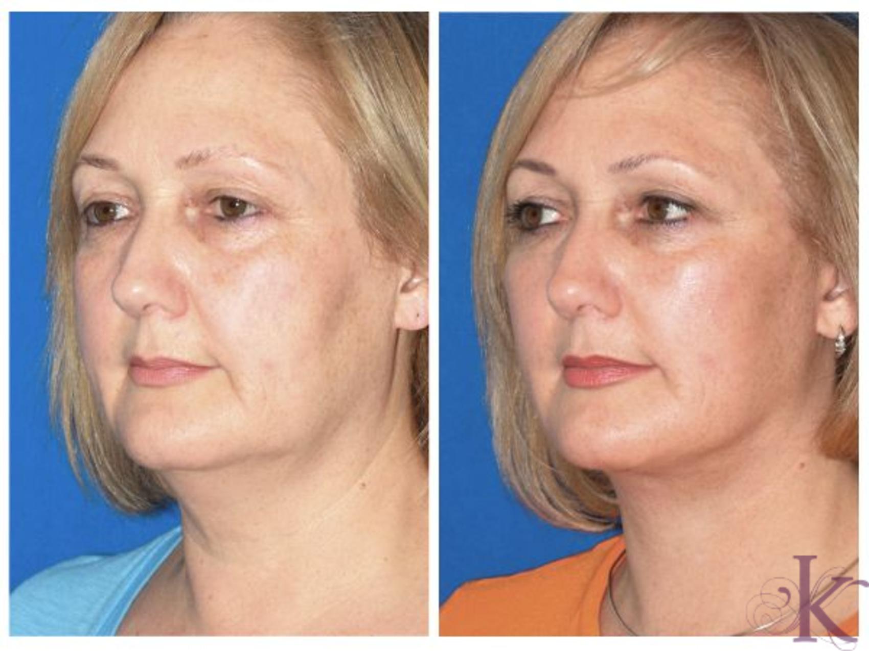 Facelift Dr. Vasyukevich Facial Plastic Surgeon NYC 52