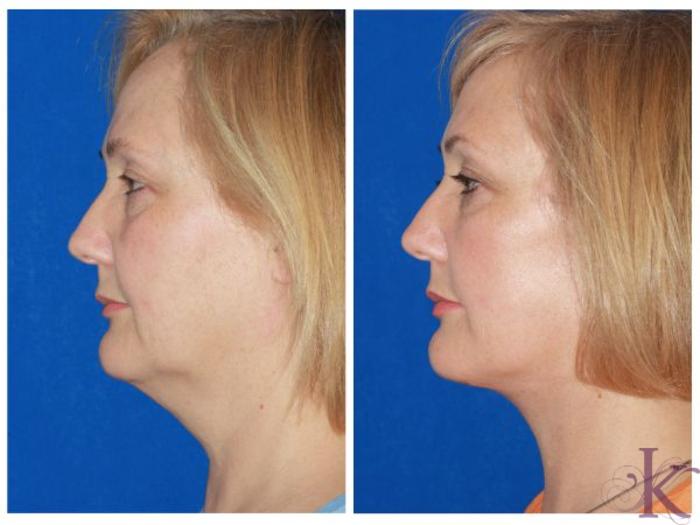 Before & After Facelift Case 52 View #3 View in New York, NY