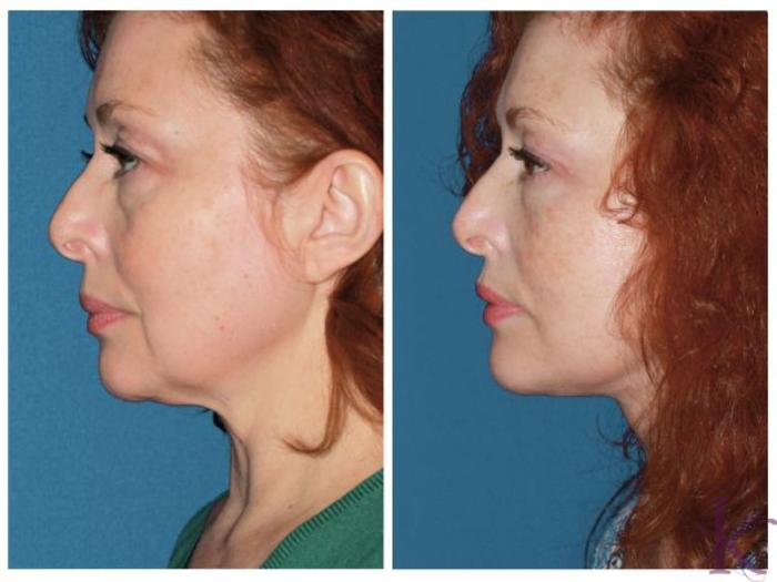 Before & After Facelift Case 53 View #3 View in New York, NY