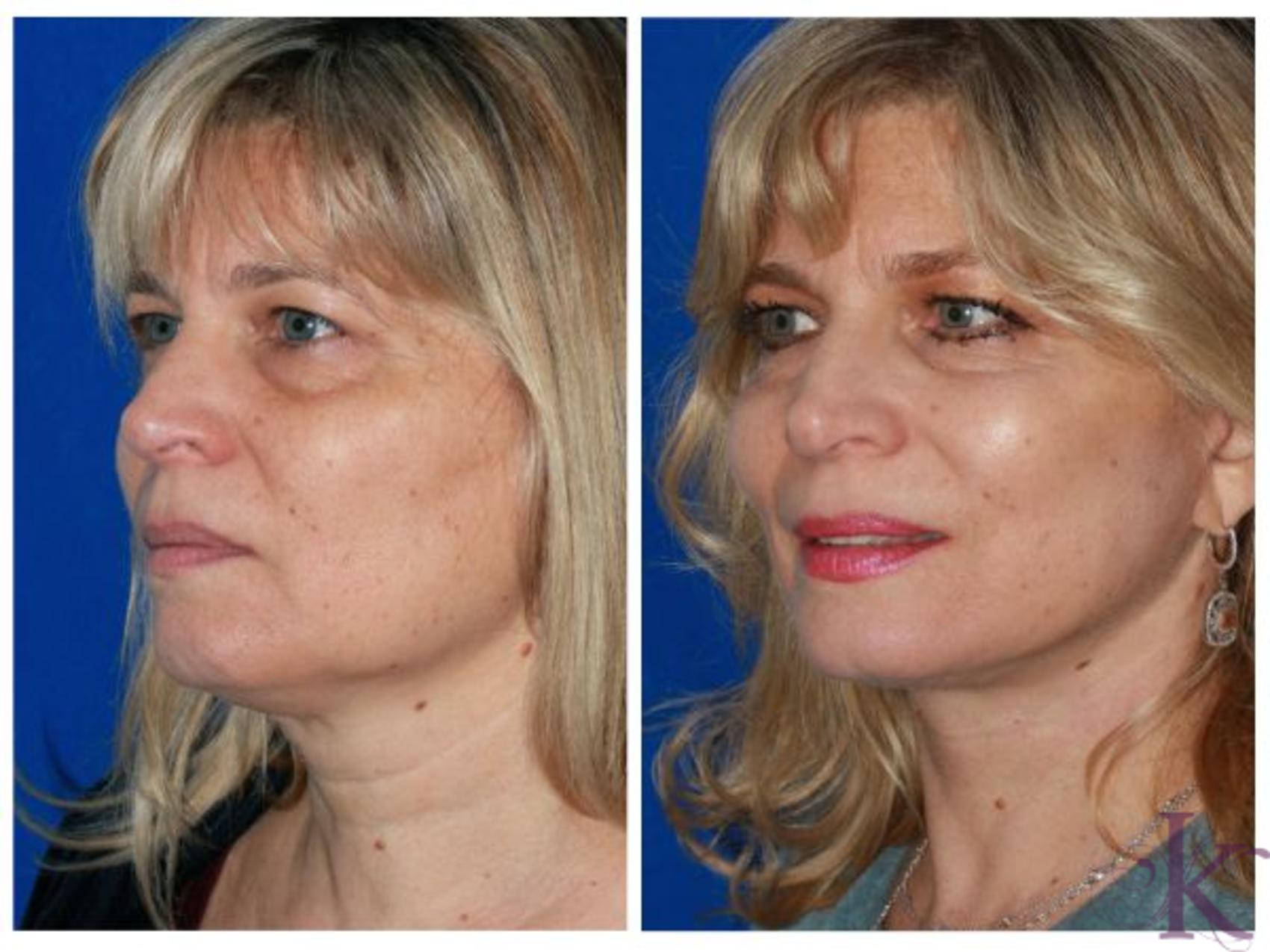 Facelift Case 65 Dr Vasyukevich Facial Plastic Surgeon Nyc