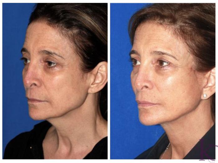 Before & After Facelift Case 98 View #3 View in New York, NY