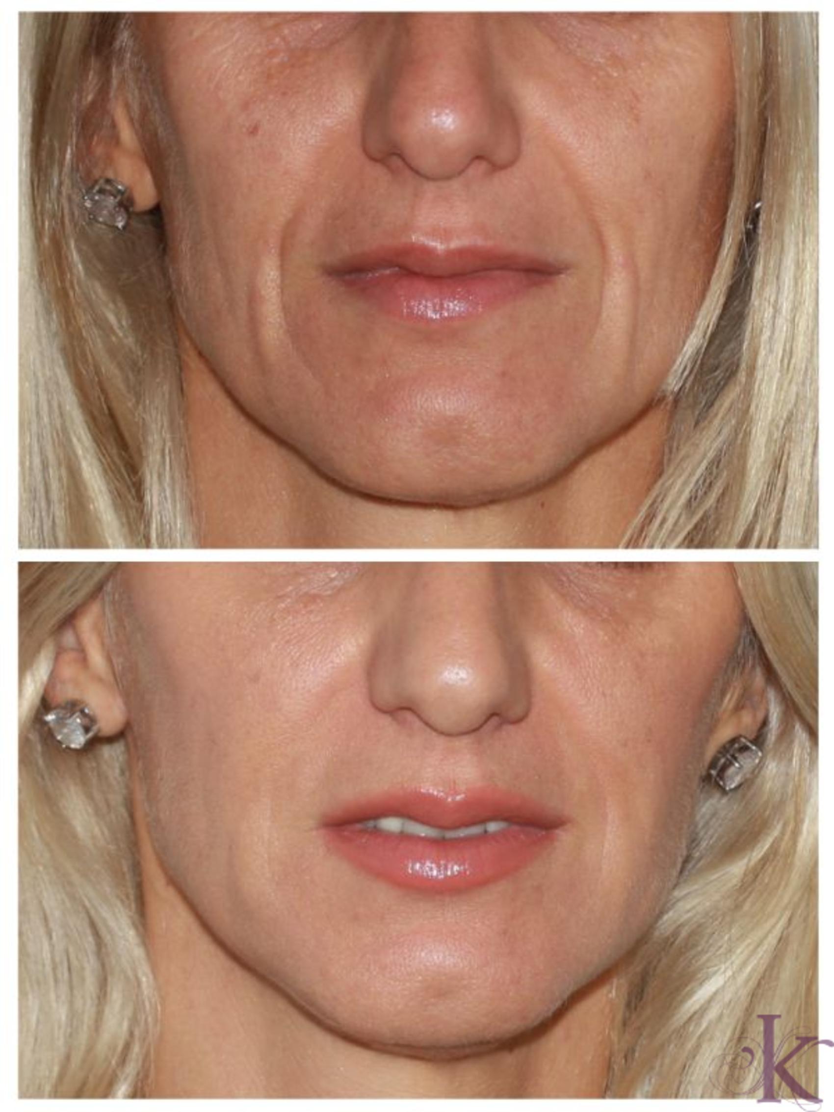 Before & After Fillers & Fat Grafting Case 101 View #1 View in New York, NY