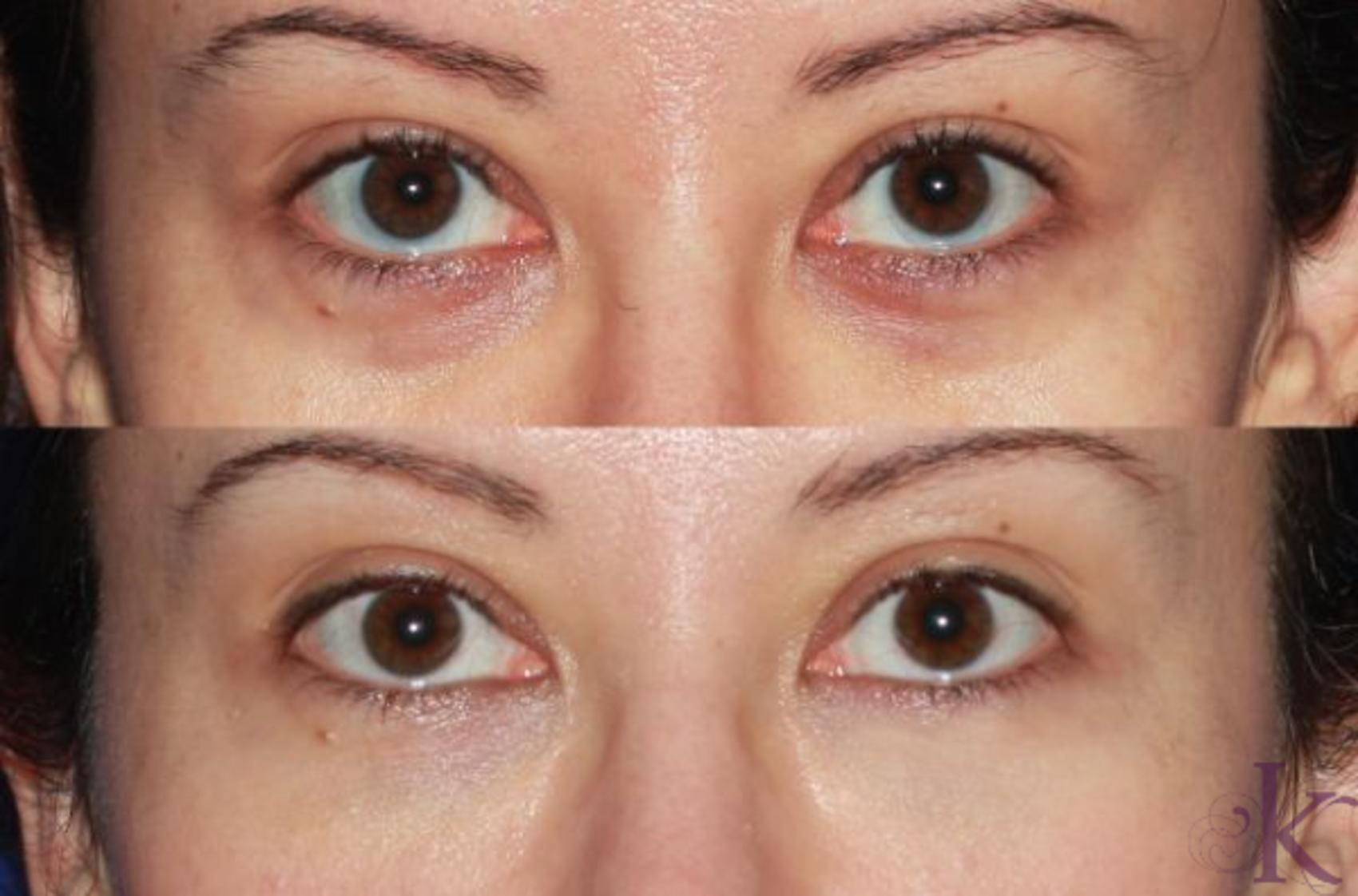 Before & After Fillers & Fat Grafting Case 33 View #1 View in New York, NY