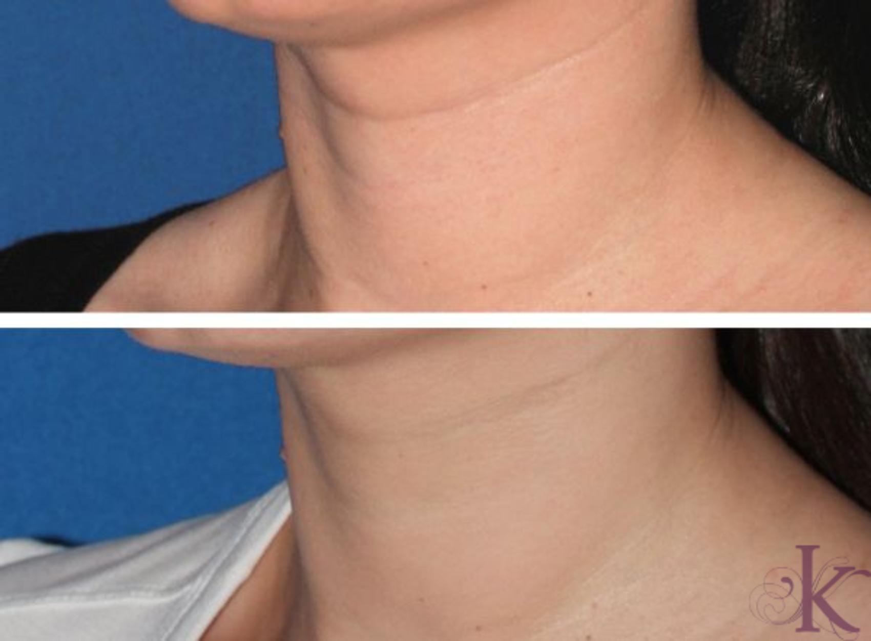 Before & After Fillers & Fat Grafting Case 35 View #1 View in New York, NY
