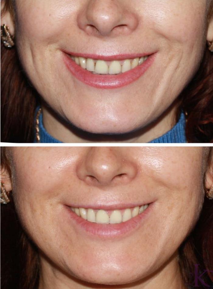 Before & After Fillers & Fat Grafting Case 38 View #1 View in New York, NY