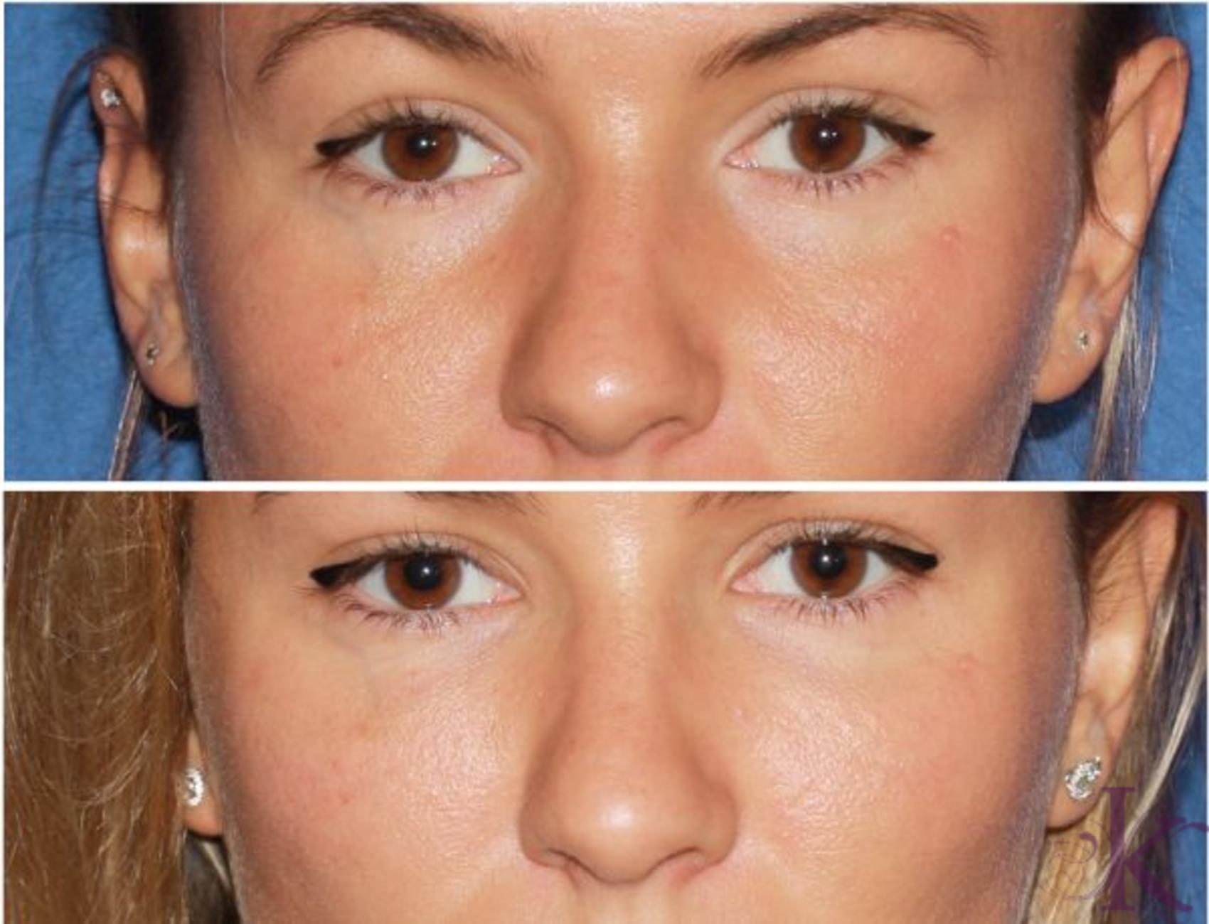 Before & After Fillers & Fat Grafting Case 39 View #1 View in New York, NY
