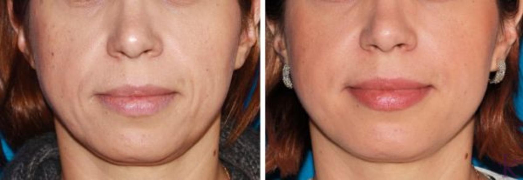 Before & After Fillers & Fat Grafting Case 55 View #1 View in New York, NY