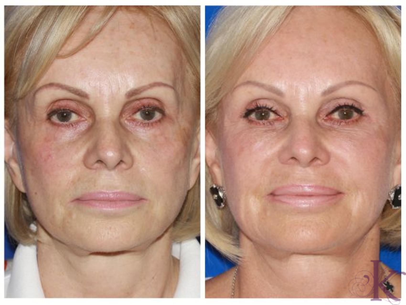 Before & After Fillers & Fat Grafting Case 63 View #1 View in New York, NY