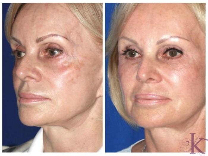 Before & After Fillers & Fat Grafting Case 63 View #2 View in New York, NY