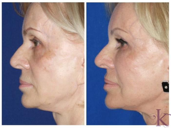Before & After Fillers & Fat Grafting Case 63 View #3 View in New York, NY