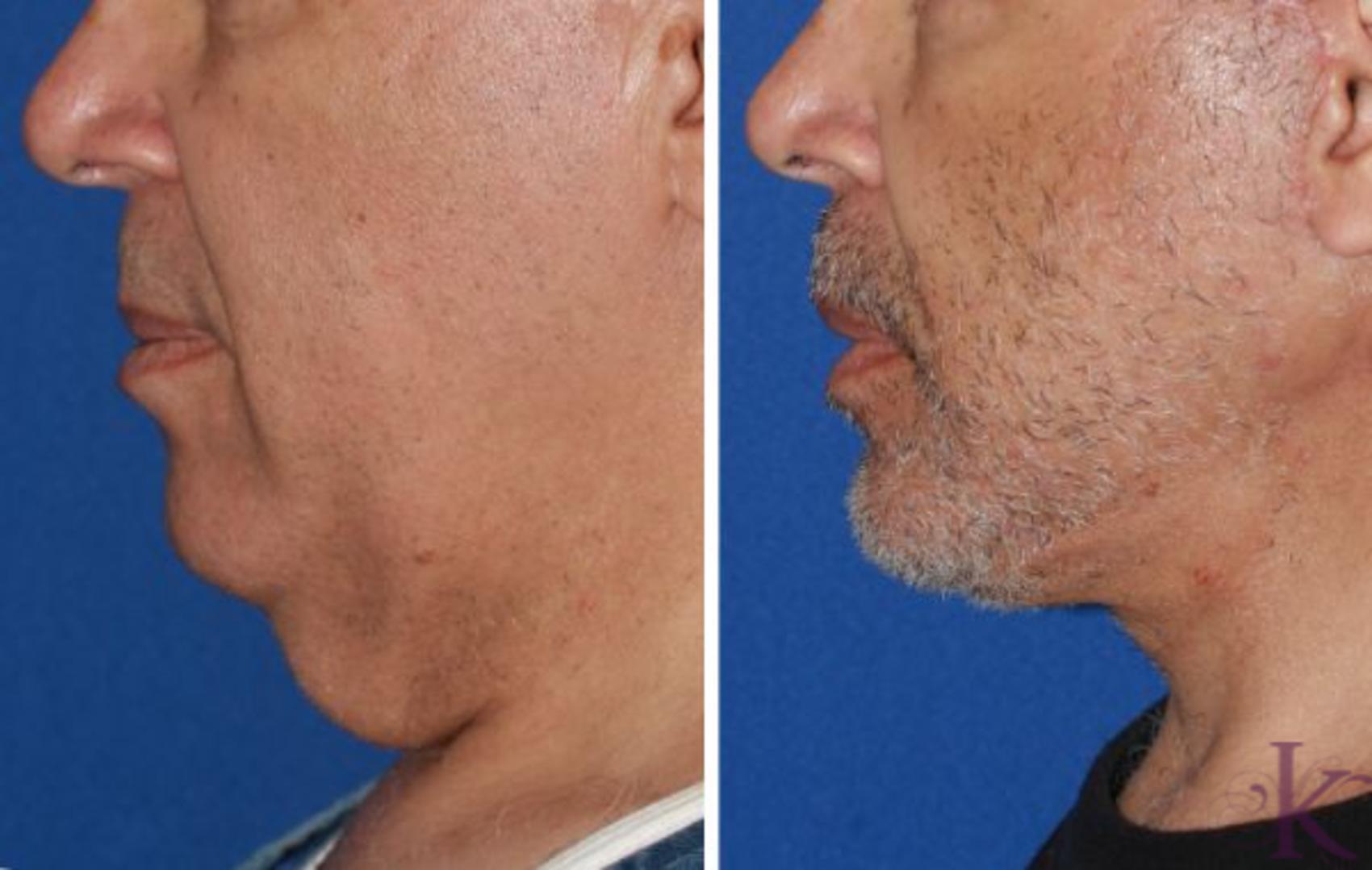 Before & After Male Face & Neck Lift Case 59 View #1 View in New York, NY