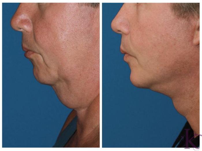 Before & After Male Face & Neck Lift Case 61 View #1 View in New York, NY