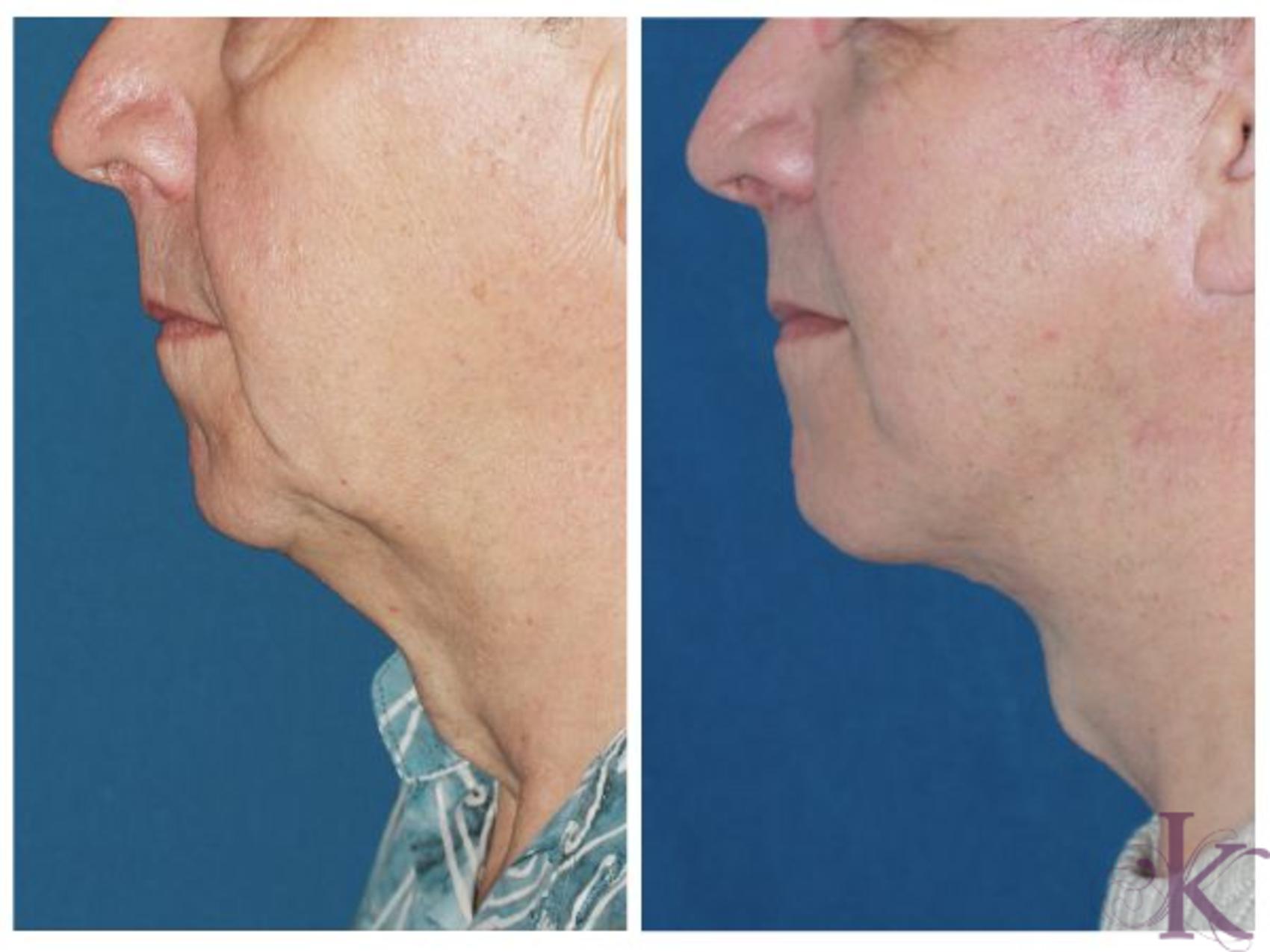 Before & After Male Face & Neck Lift Case 62 View #1 View in New York, NY
