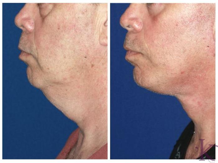 Before & After Male Face & Neck Lift Case 67 View #1 View in New York, NY