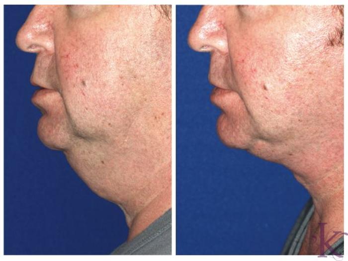 Before & After Male Face & Neck Lift Case 68 View #1 View in New York, NY