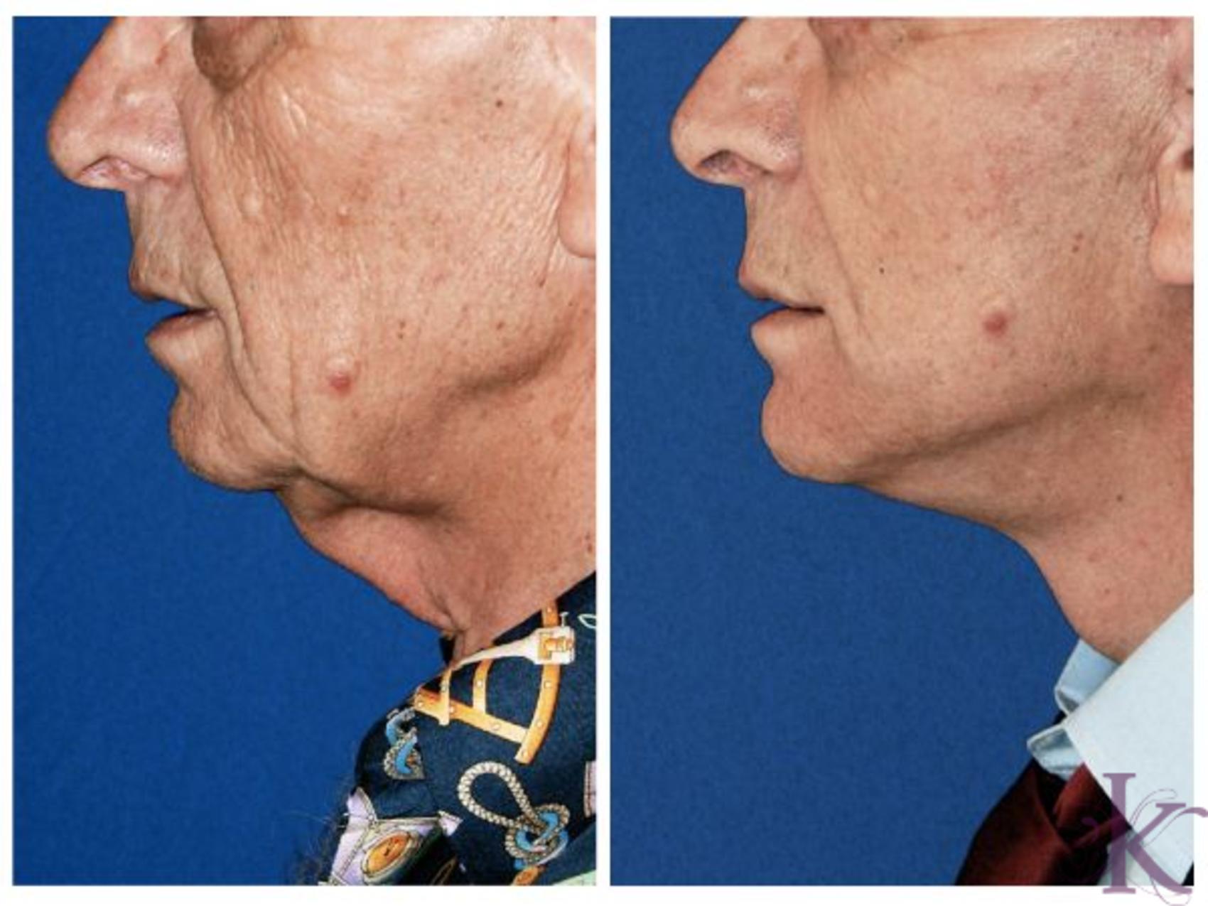 Before & After Male Face & Neck Lift Case 69 View #1 View in New York, NY