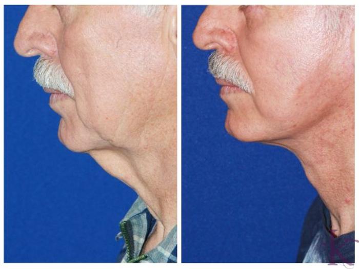 Before & After Male Face & Neck Lift Case 70 View #1 View in New York, NY
