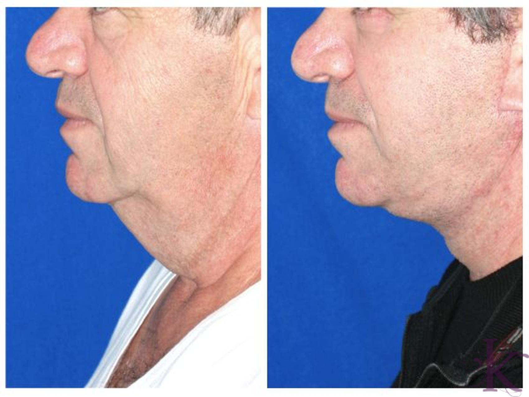 Before & After Male Face & Neck Lift Case 74 View #1 View in New York, NY