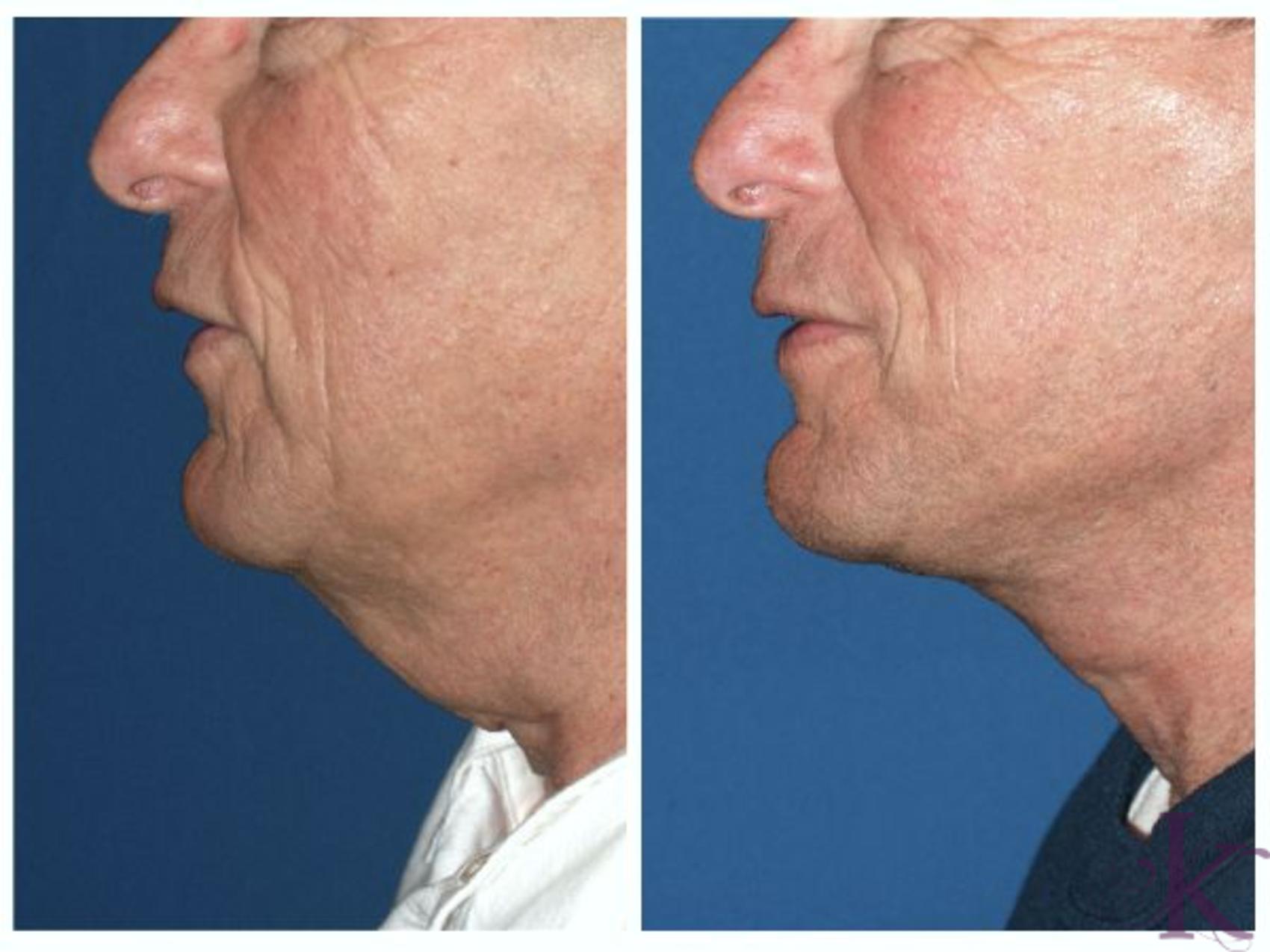 Before & After Male Face & Neck Lift Case 76 View #1 View in New York, NY